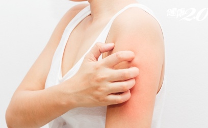 【產前須知】認識「妊娠性蕁麻疹」