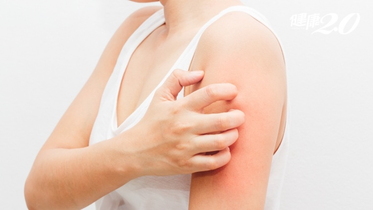 【產前須知】認識「妊娠性蕁麻疹」