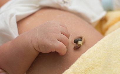 【育兒常識】新生兒臍帶息肉怎麼辦？