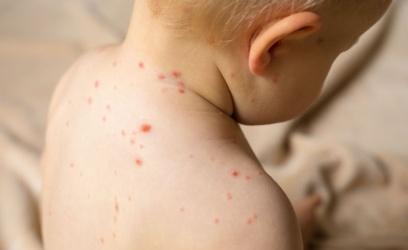 【育兒常識】何謂嬰兒病毒疹？