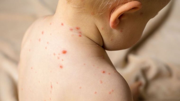【育兒常識】何謂嬰兒病毒疹？