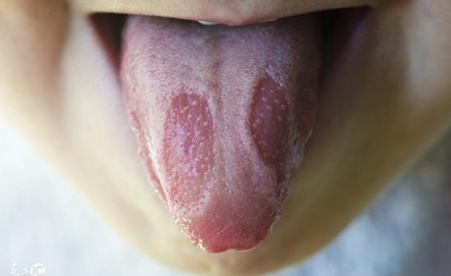 【育兒常識】何謂嬰兒「地圖舌」？