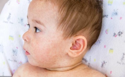 【育兒嘗試】新生兒中樞神經感染：單純性皰疹病毒（HSV）