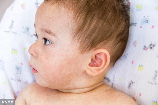 【育兒嘗試】新生兒中樞神經感染：單純性皰疹病毒（HSV）