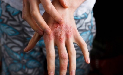 【育兒常識】異位性皮膚炎照護