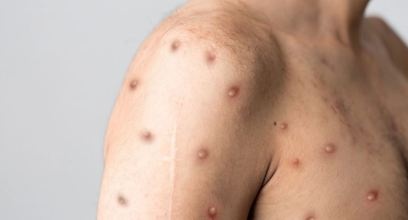 【育兒常識】什麼是猴痘？