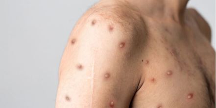 【育兒常識】什麼是猴痘？